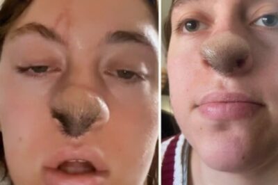 ¡La increíble historia de la mujer que, tras ser mordida por un perro en la nariz, empezó a notar un extraño crecimiento de vello! Lo que sucedió después transformó su rostro de una manera impactante.